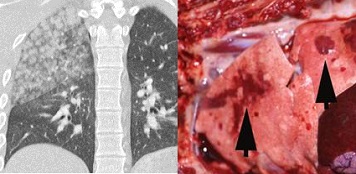 stachybotrys disease-lungs